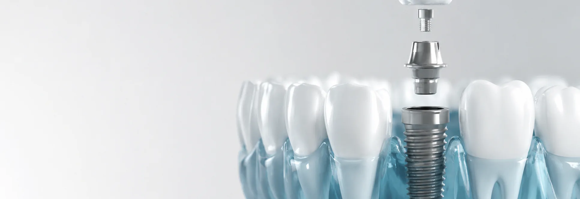 Computer guided dental implants at SmilePro Dental