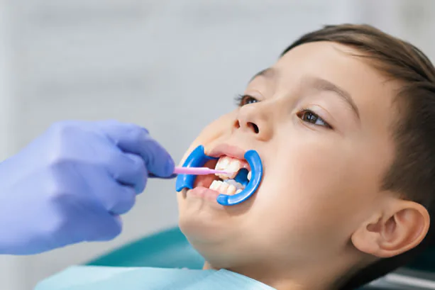 Dental sealants applied to teeth at SmilePro Dental
