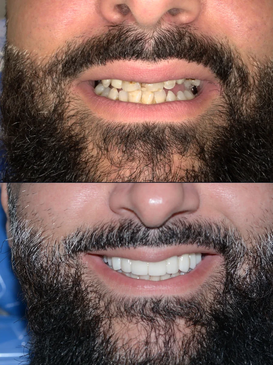 SmilePro Dental case 1, smile transformation — the patient's smile before treatment above, and after treatment below
