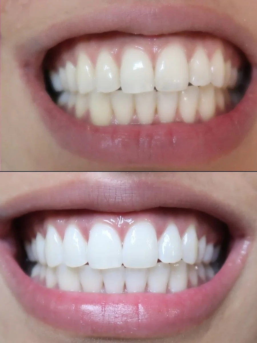 SmilePro Dental case 10, smile transformation — the patient's smile before treatment above, and after treatment below