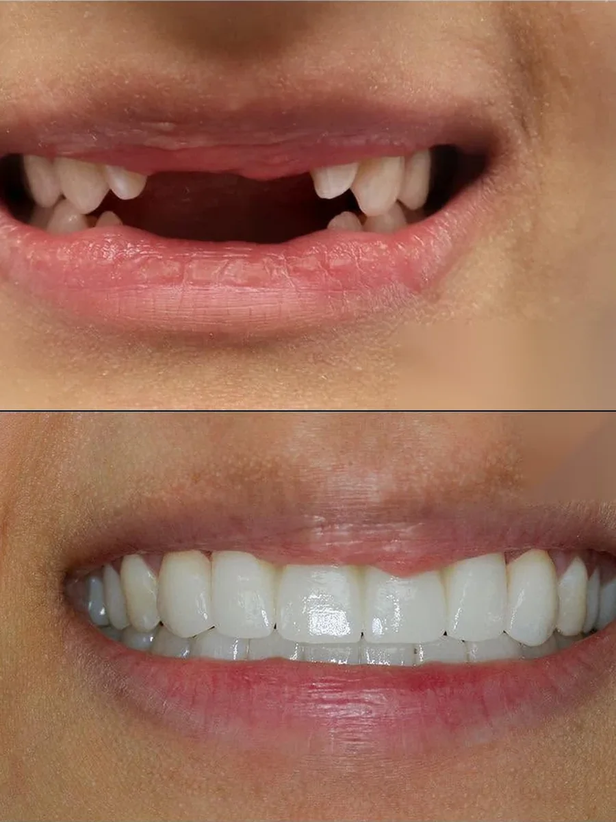 SmilePro Dental case 2, smile transformation — the patient's smile before treatment above, and after treatment below
