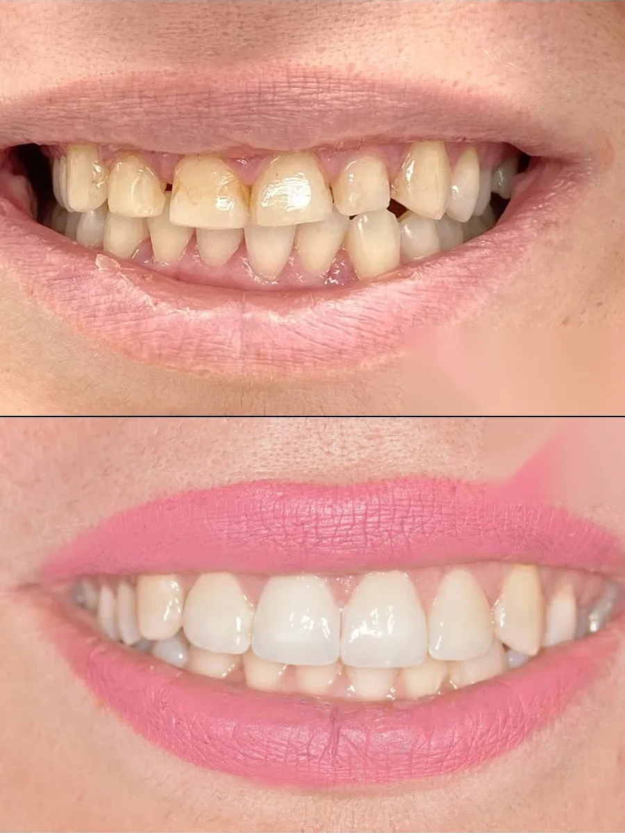SmilePro Dental case 3, smile transformation — the patient's smile before treatment above, and after treatment below