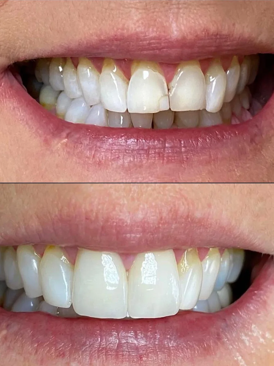 SmilePro Dental case 4, smile transformation — the patient's smile before treatment above, and after treatment below