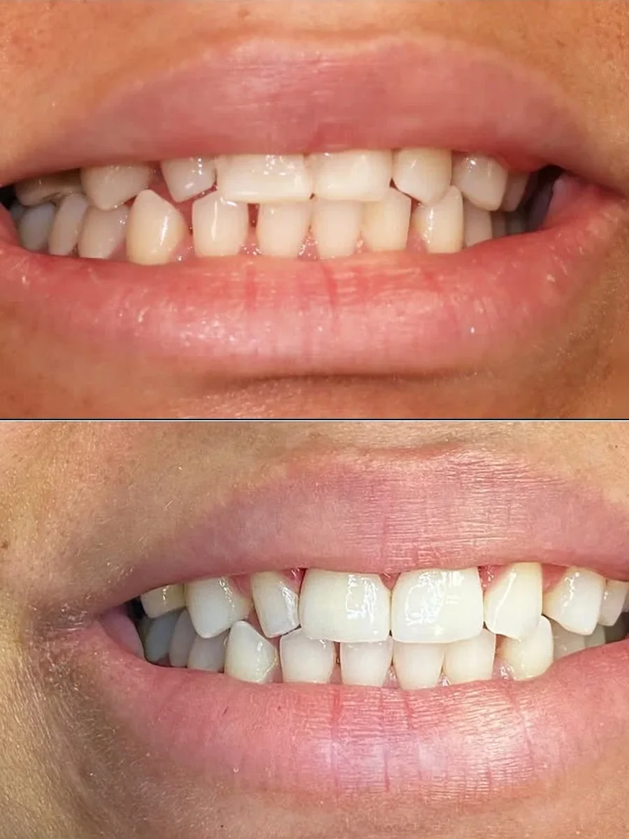 SmilePro Dental case 5, smile transformation — the patient's smile before treatment above, and after treatment below