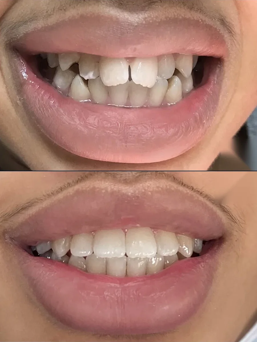 SmilePro Dental case 6, smile transformation — the patient's smile before treatment above, and after treatment below