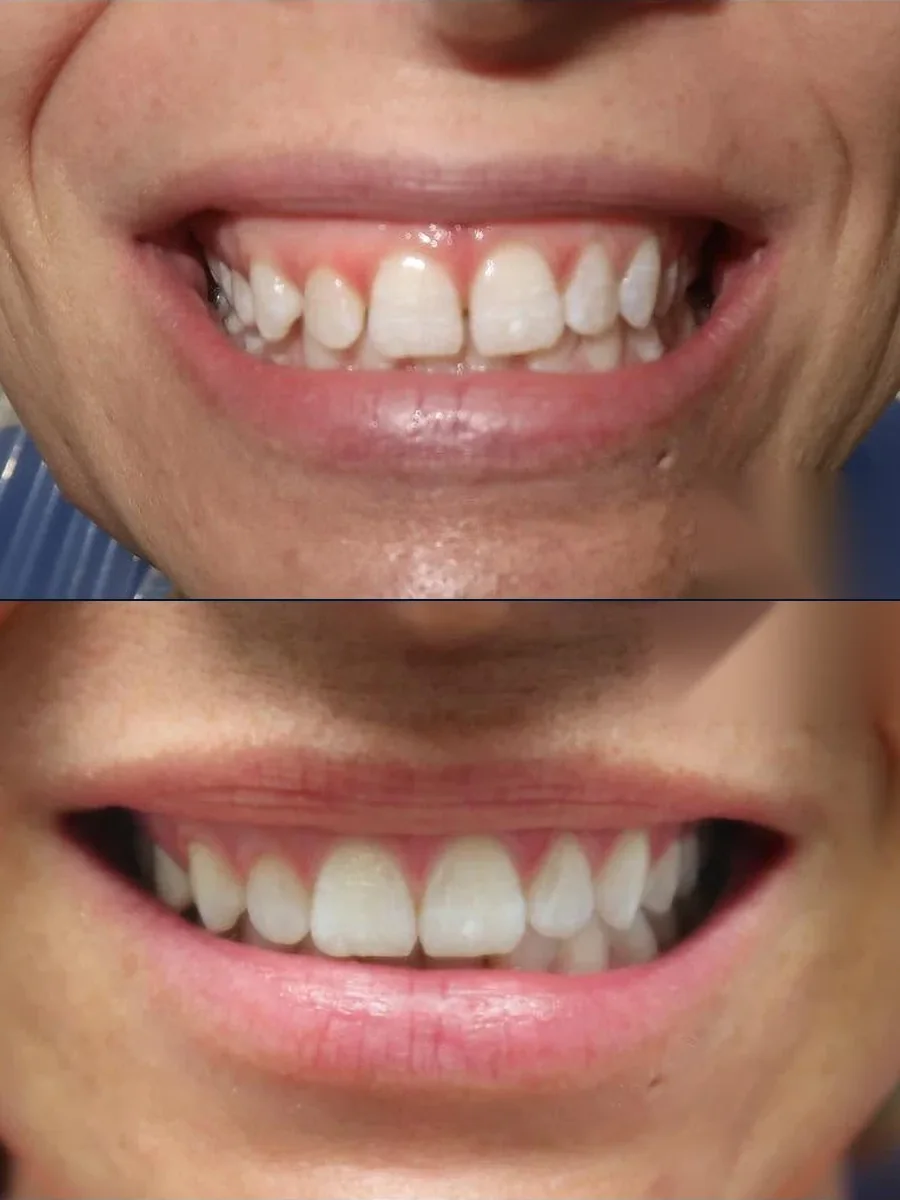 SmilePro Dental case 7, smile transformation — the patient's smile before treatment above, and after treatment below