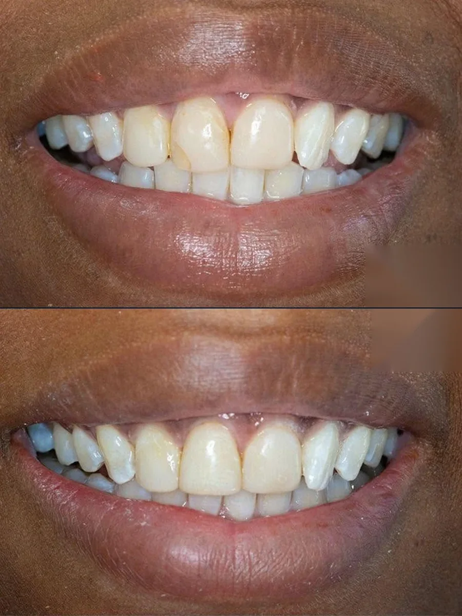 SmilePro Dental case 8, composite bonding — the patient's smile before treatment above, and after treatment below