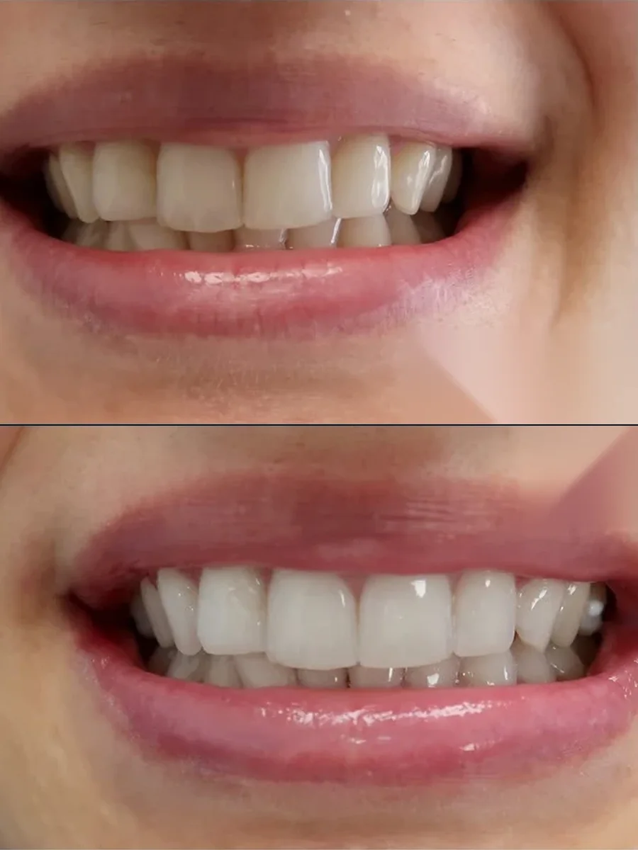 SmilePro Dental case 9, teeth whitening — the patient's smile before treatment above, and after treatment below