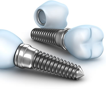 Implant dentist in Dearborn Heights