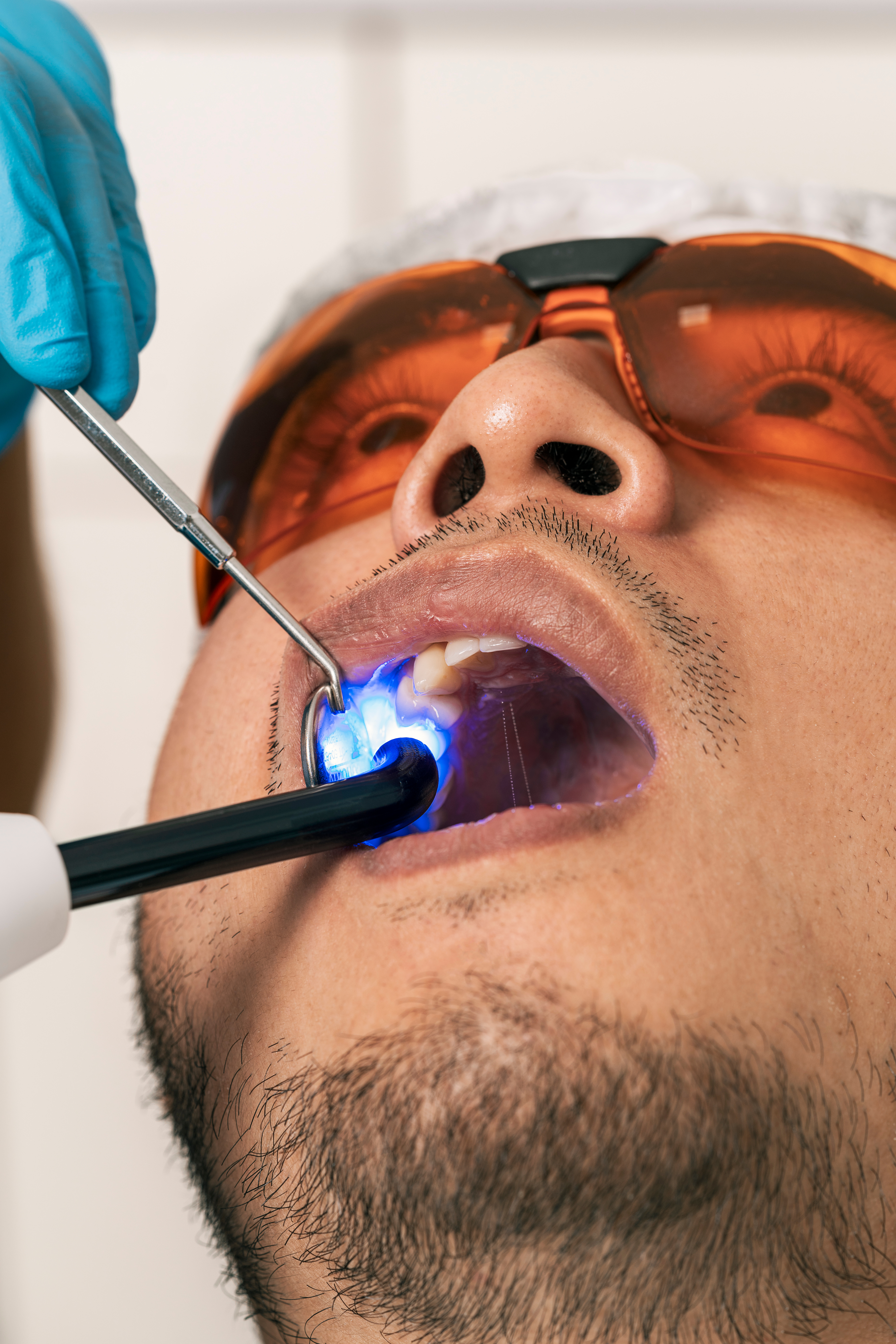 Vertical photo with close-up view of a dentist whitening a patient's teeth with laser in a clinic